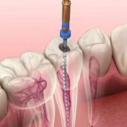 root canal treatment