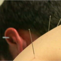 acupuncture-blogSpan