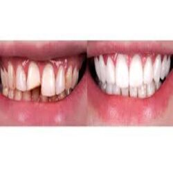 Dental restoration