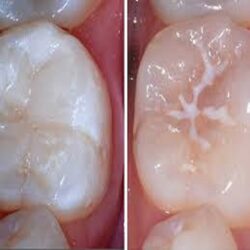 Fissure sealing