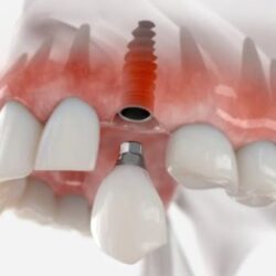 Dental implant