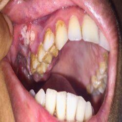 oral cancer